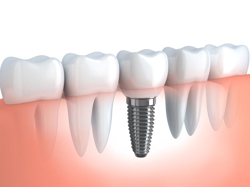 Dental Implants  Roseville, CA 
